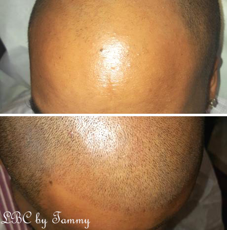 Scalp Pigmentation